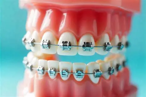 Orthodontic Braces