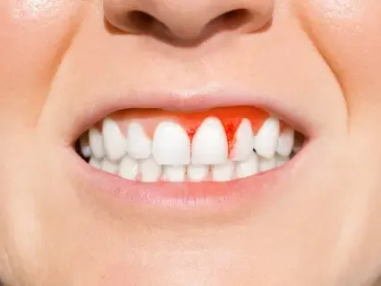 Gum Disease Treatment