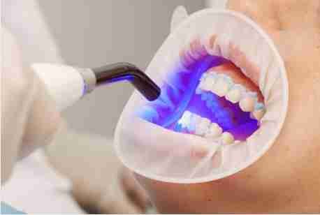 Light Cure Filling